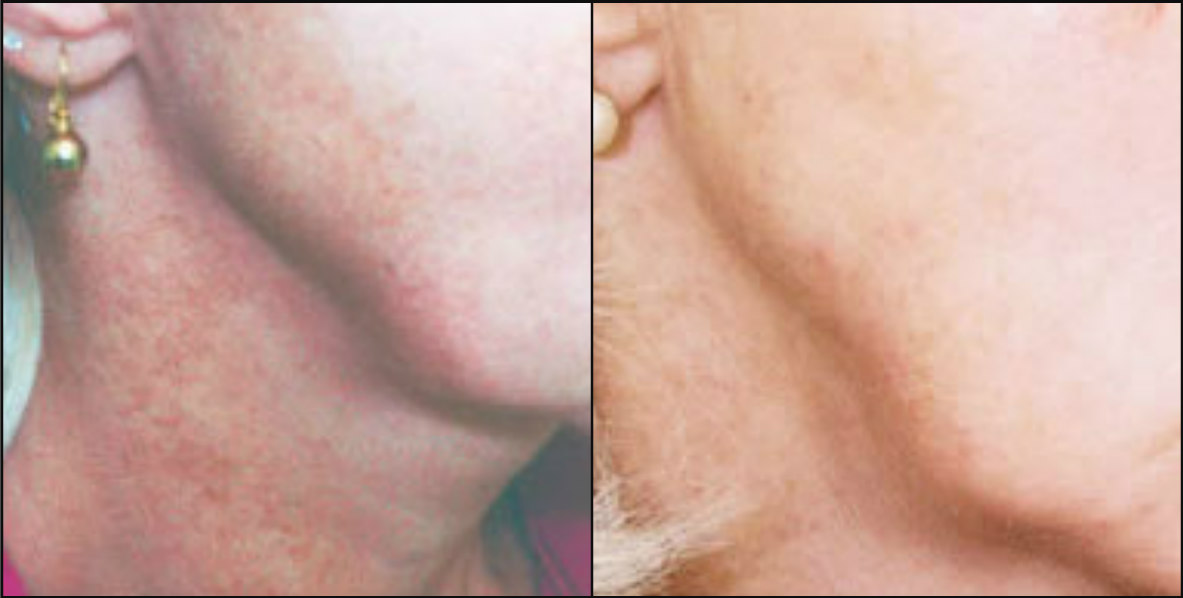 Melasma - Before & After
