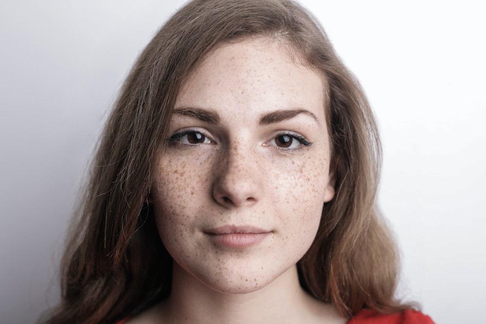 woman with melasma