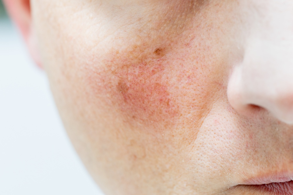 woman with facial redness